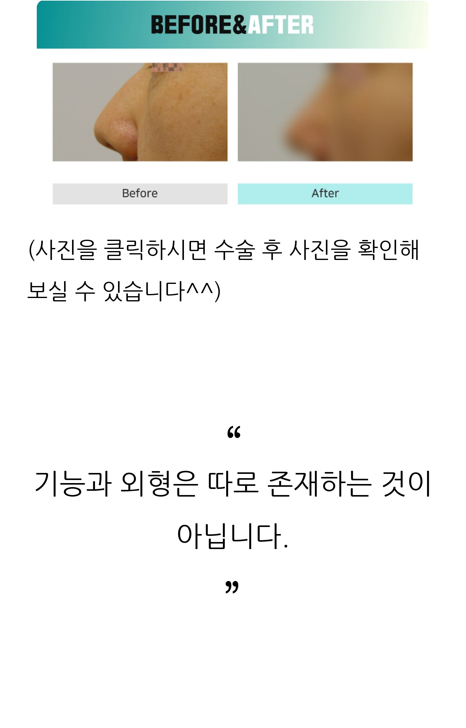 청주 두리이비인후과 비중격만곡증·매부리코 안내 11