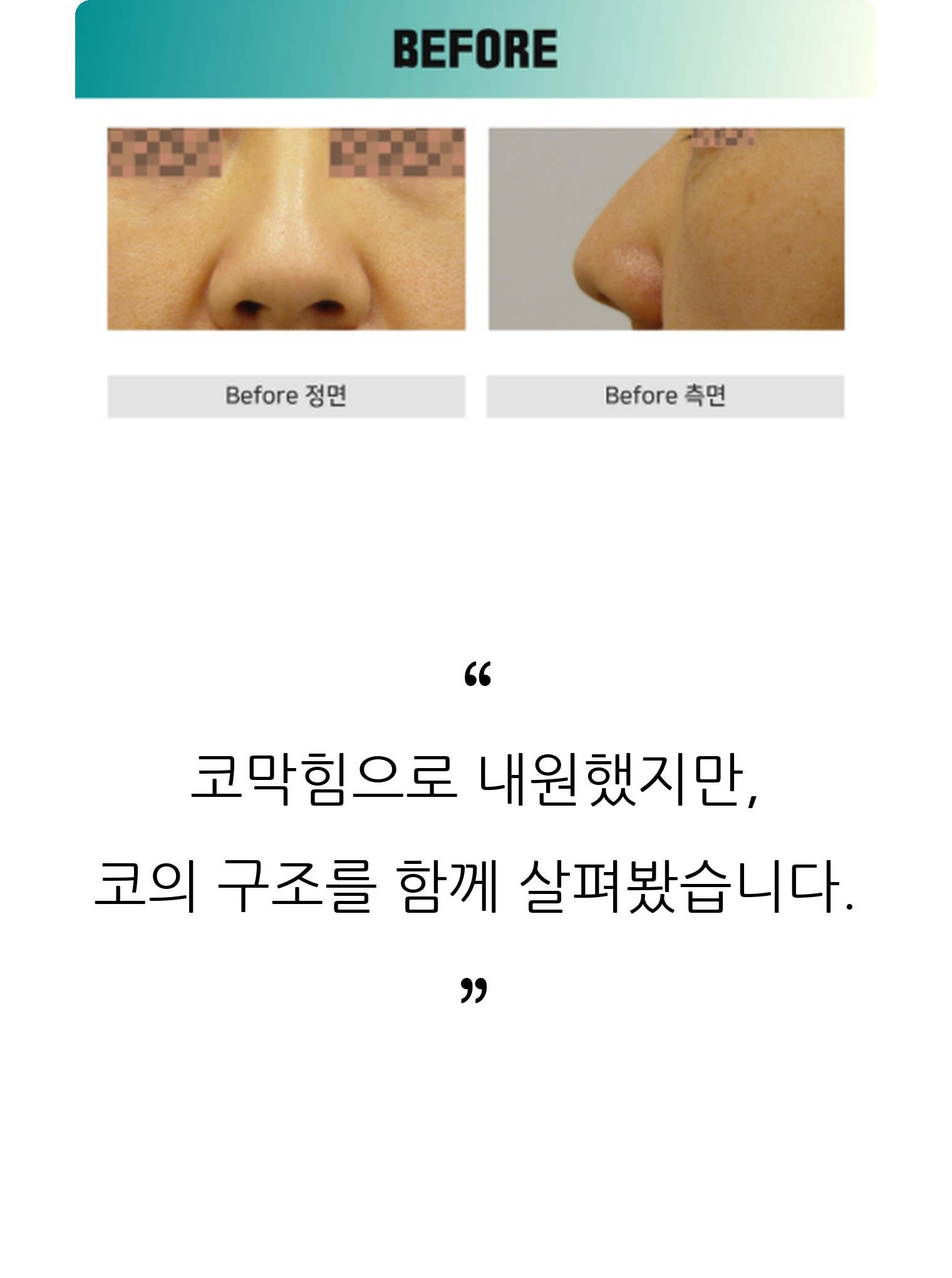 청주 두리이비인후과 비중격만곡증·매부리코 안내 3