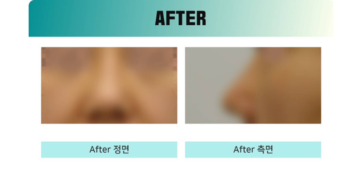 청주 두리이비인후과 비중격만곡증·매부리코 안내 9