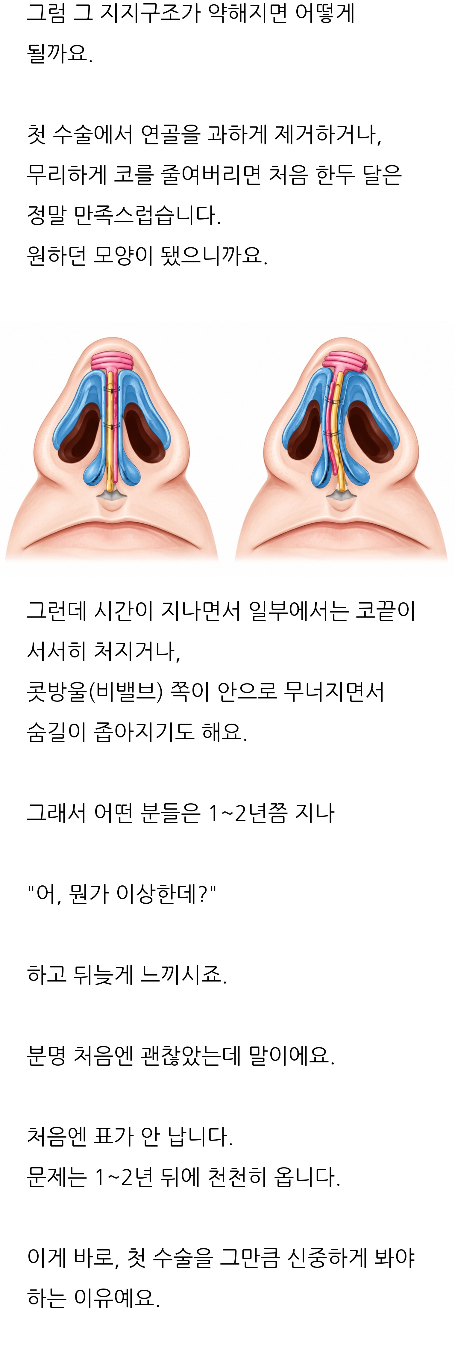 청주 두리이비인후과 비중격만곡증·매부리코 안내 9